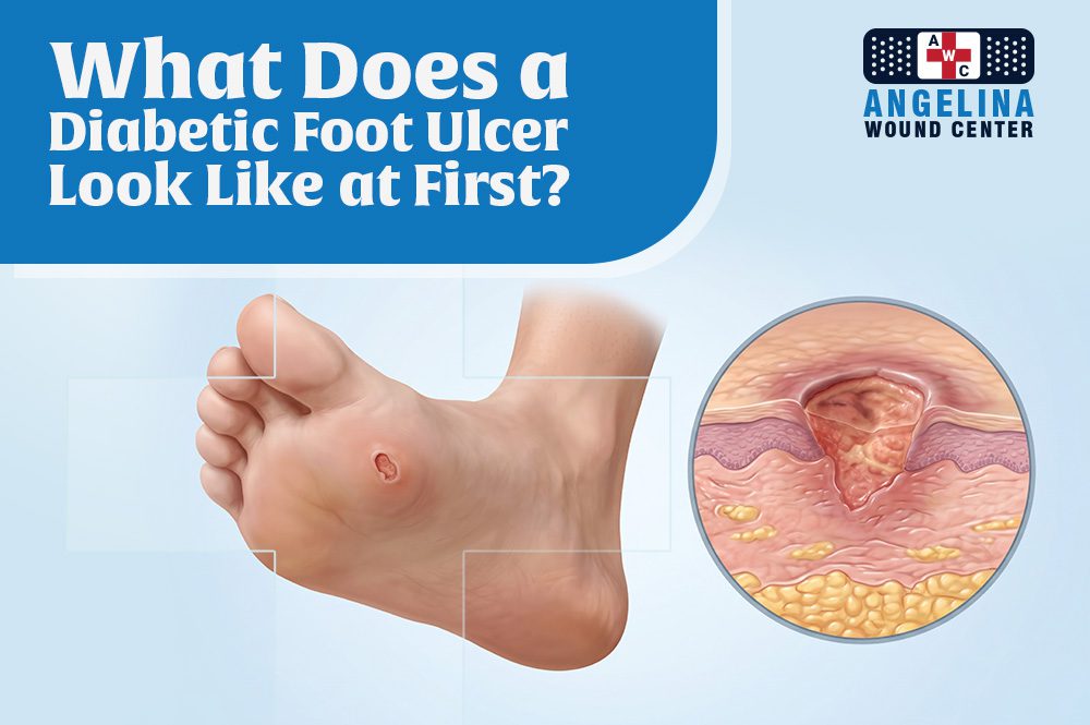 Diabetic Foot Ulcer